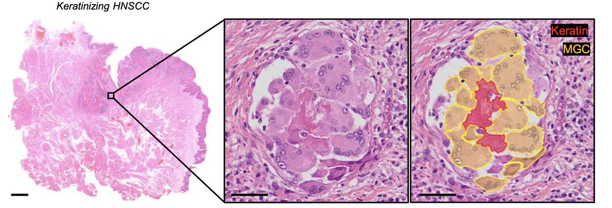 GorphePhilippe's tweet image. Multinucleated giant macrophages in head & neck cancer:
amazing translational & AI work from @GregoireGessain and @FGinhoux labs !
@GustaveRoussy @Institut_cancer PRT-K 2023 @SFPathol @FondationARC
aacrjournals.org/cancerdiscover…