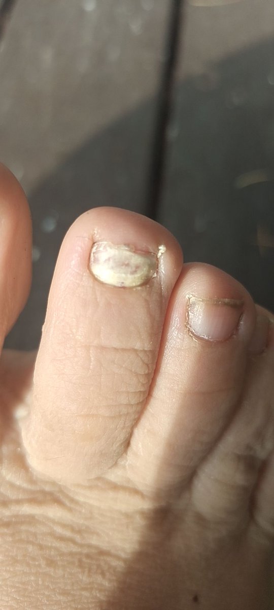 pengbdsm's tweet photo. 传统中药治灰指甲，百试百灵
涂药水十天左右，刮了，再长出来就是好的 https://t.co/Y3tzPzTqPr