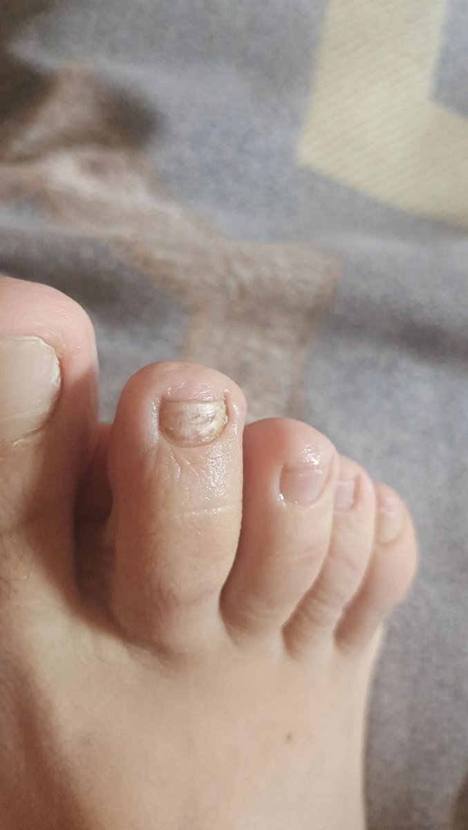 pengbdsm's tweet photo. 传统中药治灰指甲，百试百灵
涂药水十天左右，刮了，再长出来就是好的 https://t.co/Y3tzPzTqPr