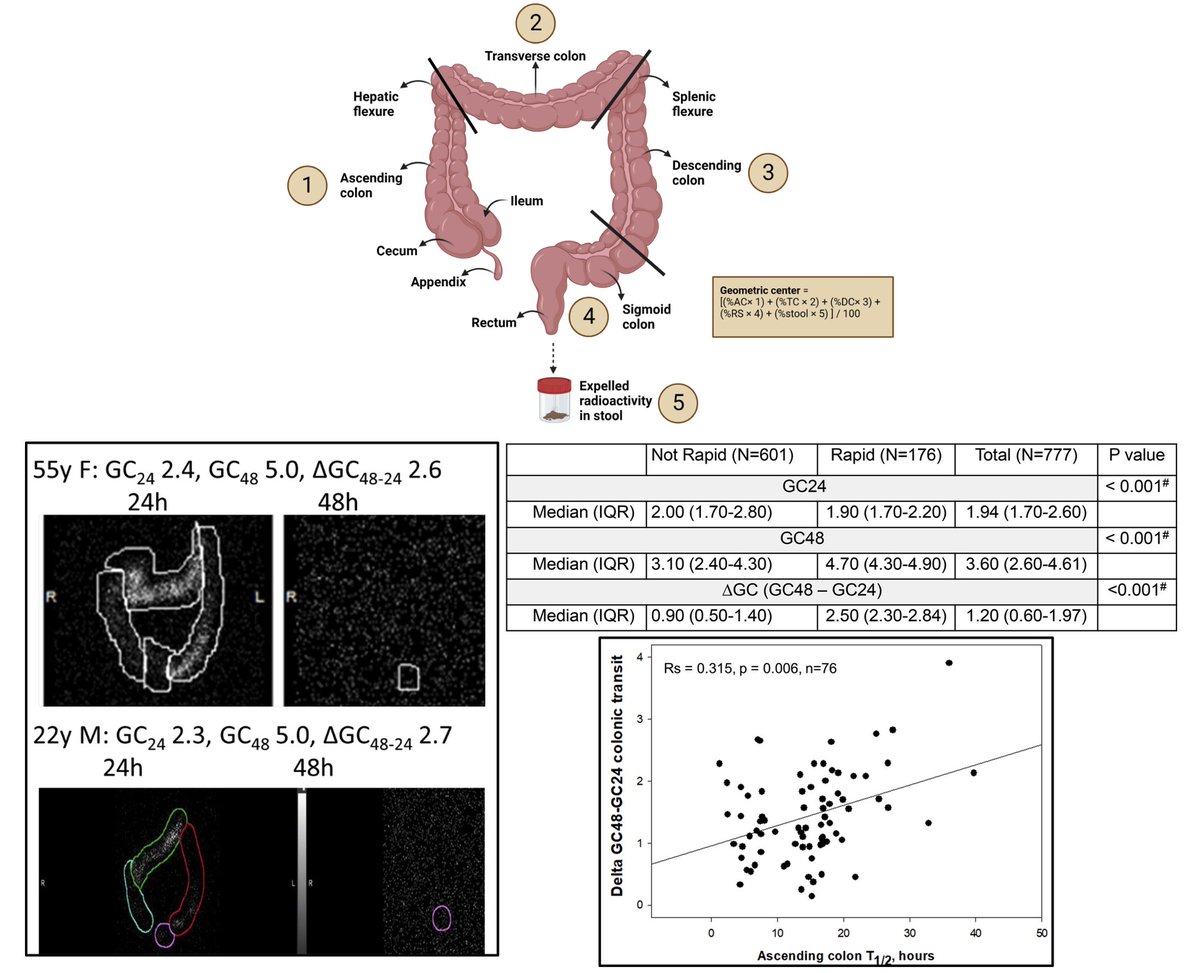 NGMJournal's tweet photo. 🆕🔥Additional criteria on #scintigraphic testing for diagnosis of #RapidColonicTransit in patients with #ChronicDiarrhea‼️
🎯Delta🔼#GC 48–24 h identifies additional patients with diarrhea associated with #rapid CT @MayoClinicGIHep
👉https://t.co/Zb4H62Kflz
@ANMSociety @esnm_eu https://t.co/ysrFj6t36C