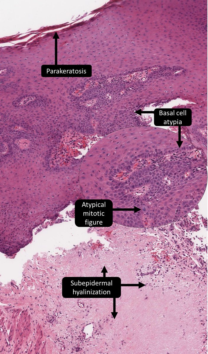 Charles Herndon (@drcyclopath) on Twitter photo 70F vulvar irritation, diagnosis?
A) Lichen sclerosus et atrophicus
B) Lichen planus
C) Differentiated VIN
🔬dpa-dapa.com/public/present…
#GYNpath #PathTwitter #Pathology
🙏 <a href="/HassellLewis/">Lewis Hassell</a> 70F vulvar irritation, diagnosis?
A) Lichen sclerosus et atrophicus
B) Lichen planus
C) Differentiated VIN
🔬dpa-dapa.com/public/present…
#GYNpath #PathTwitter #Pathology
🙏 <a href="/HassellLewis/">Lewis Hassell</a>