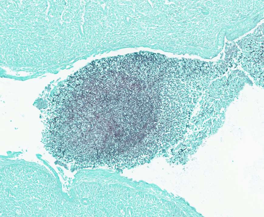 pascalisID's tweet photo. Those attending our Mycology course this week will be reviewing histopathology of explanted lungs

https://t.co/jIp2k7cWOC https://t.co/3ASJ3osfy0