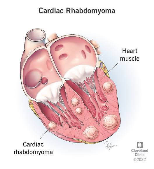 มะเร็งกล้ามเนื้อหัวใจ 
(Cardiac Rhabdomyosarcoma)

เป็น case report ทั้งหมดเลย เจอได้ยากมาก
อาการ : ใจสั่นจากหัวใจเต้นผิดจังหวะ หน้าบวม ขาบวม น้ำท่วมปอด ไอปนเลือด(กระจายไปปอด)
การรักษา : การผ่าตัด ฉายแสง ให้เคโม ส่วนใหญ่ไม่ตอบสนองการรักษา 

ขอให้เดินทางไกลอย่างสงบค่ะ 🙏🏻