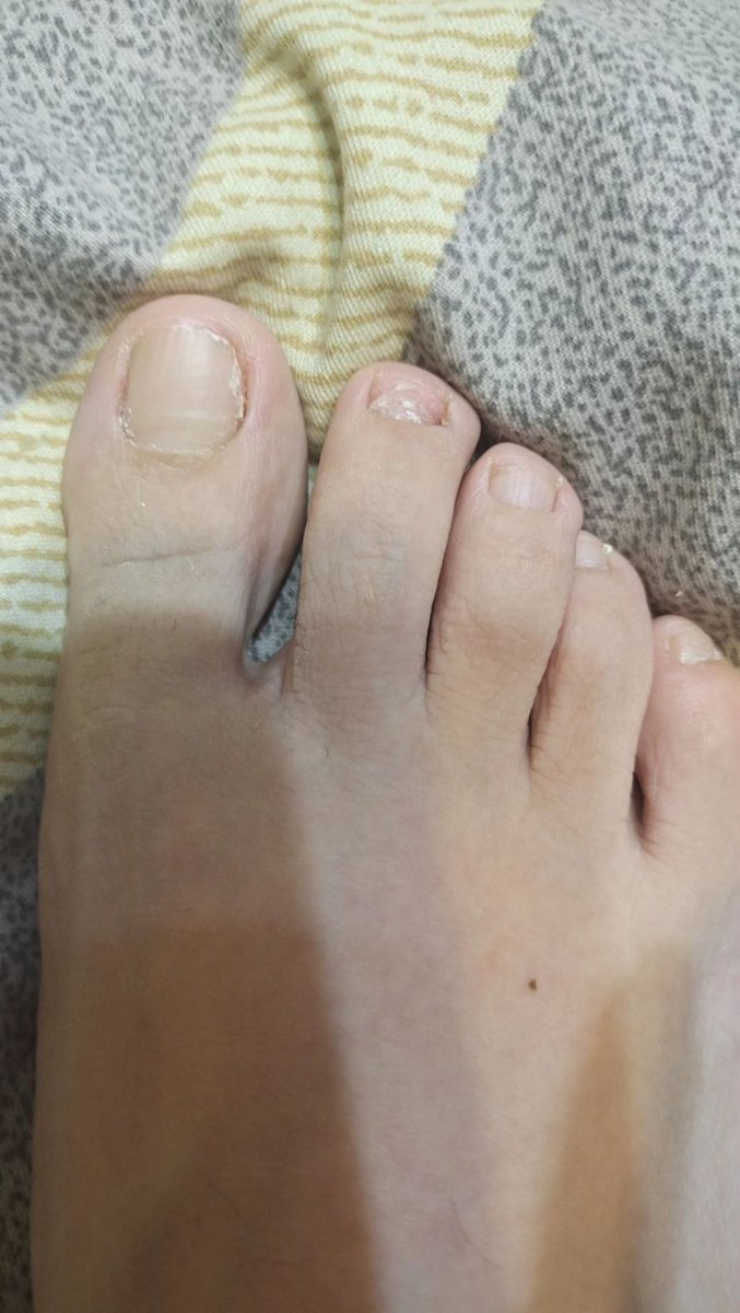 pengbdsm's tweet photo. 我有老中医配置的中药水，我自己用了十天，刮干净，长了两个月，指甲和正常的一样了，只要两位数！我现在为药水代言！现在网络骗子多，谁的话都没什么公信力，我只能发誓了，我撒谎叫我单身一辈子，被男人骗，你说有谁为了两位数诅咒自己，所以我说的都是真的，不卖日本人 https://t.co/wH0S9FAQj9