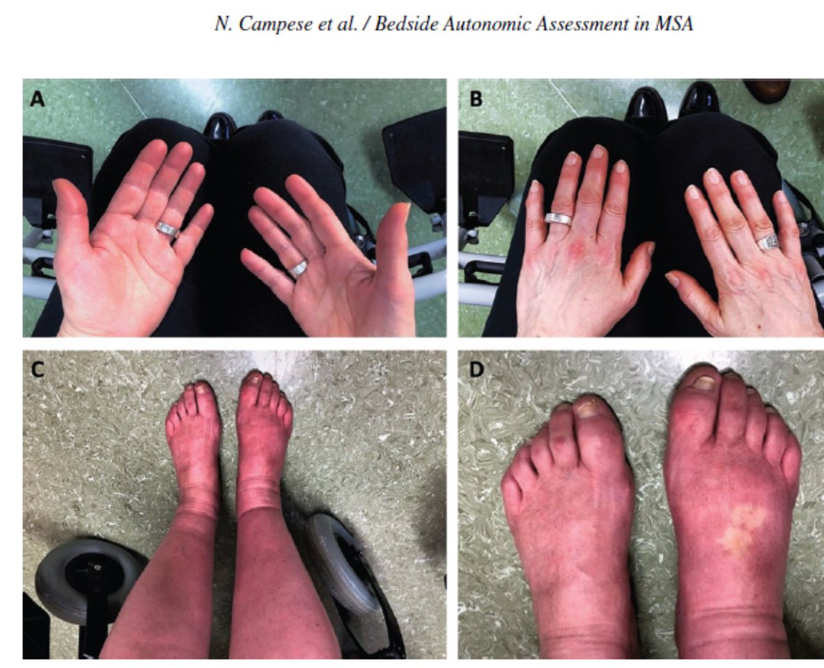 Purple hands and purple feet of Multiple System Atrophy. This is a vasomotor autonomic dysfunction and nice paper in <a href="/journal_PD/">Journal of Parkinson's Disease</a> by Campese and colleagues.