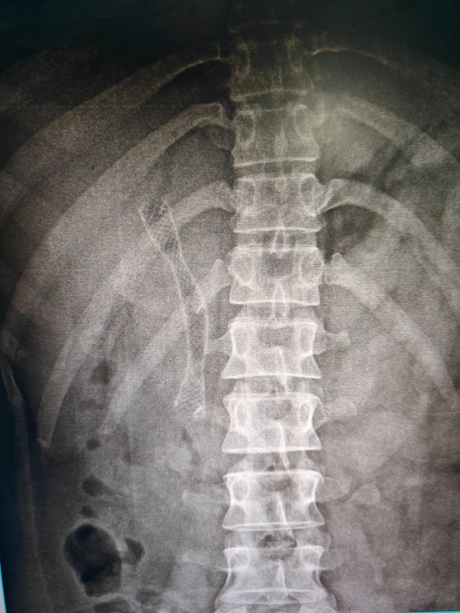drsunil_bhat's tweet photo. Post cholecystectomy- Bismuth Type 1 stricture: ERCP and placement of Fully covered SEMS. @GIscope_updates @EndoCollabcom @ASGEendoscopy @EndoscopyOA https://t.co/lsN4QsCXyJ