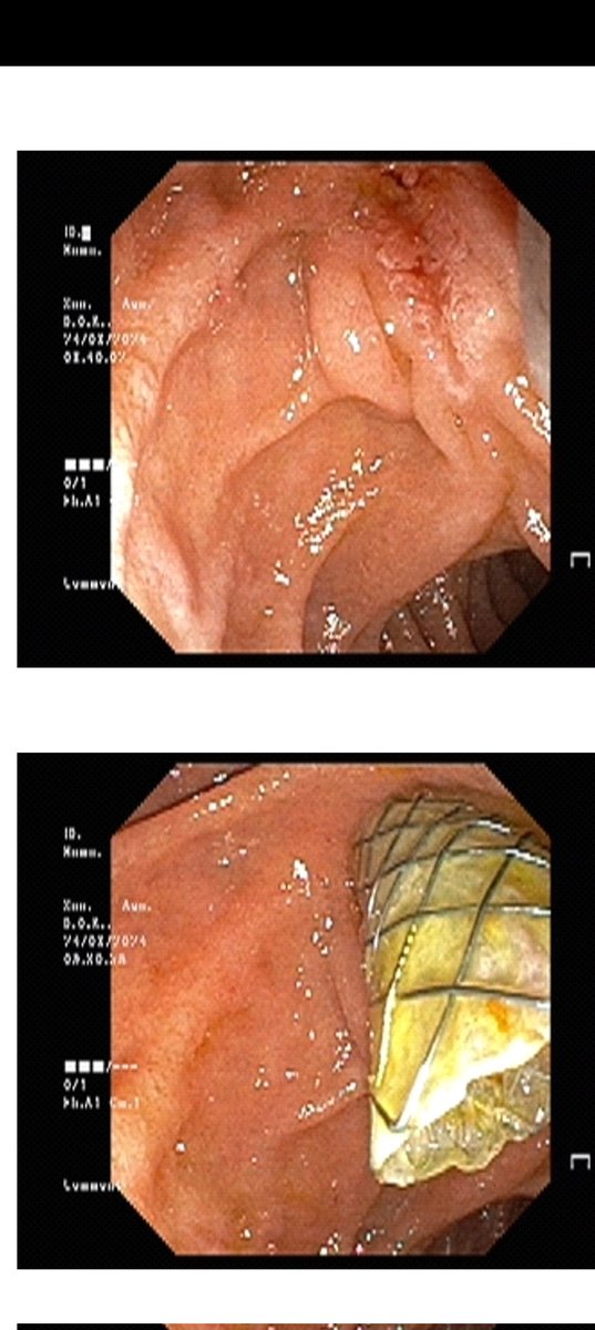 drsunil_bhat's tweet photo. Post cholecystectomy- Bismuth Type 1 stricture: ERCP and placement of Fully covered SEMS. @GIscope_updates @EndoCollabcom @ASGEendoscopy @EndoscopyOA https://t.co/lsN4QsCXyJ