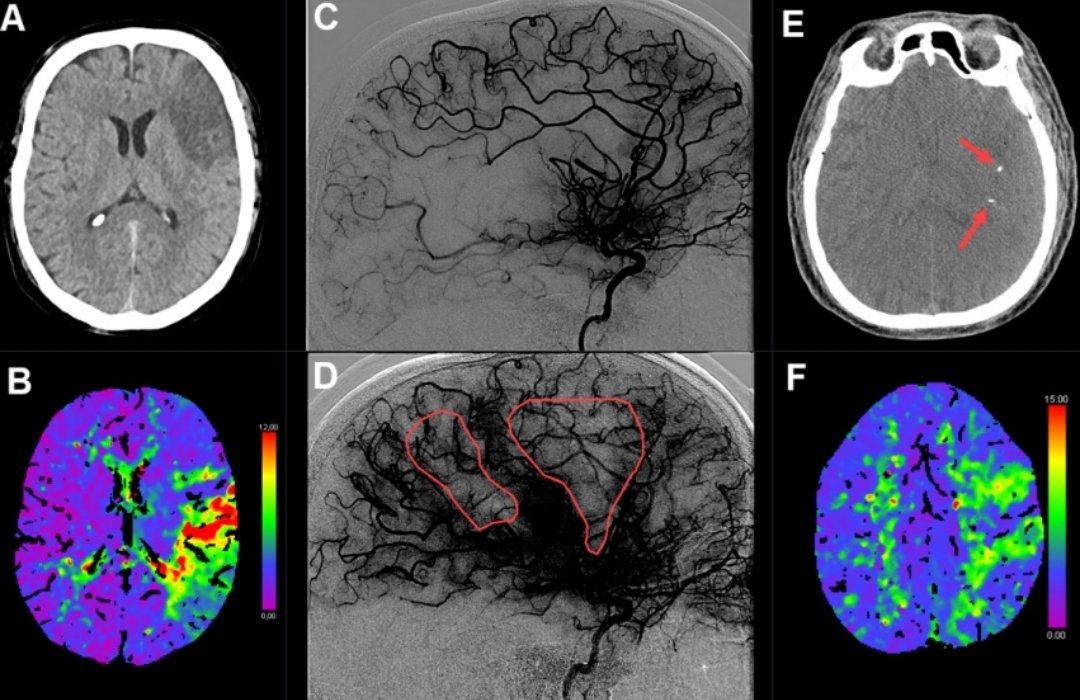 Look for the DOTs ⚪️⚫️ Flat-panel non-contrast CT could be enough to indicate which patients will have persistent hypoperfusion (and poor outcome) post-EVT 
⬇️⬇️⬇️

jnis.bmj.com/content/early/…