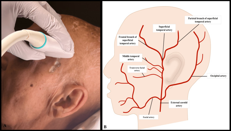 Rheumatology's tweet photo. Temporal Artery Ultrasound for the Diagnosis of Giant Cell Arteritis in the Emergency Department

https://t.co/PqWzE4z556 https://t.co/wMkCbdjVIY