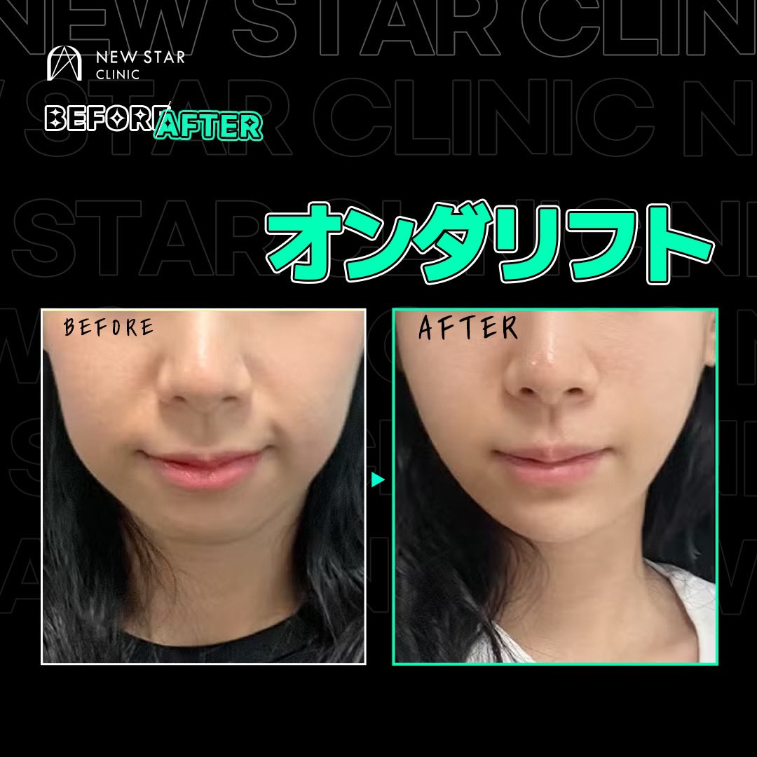 オンダリフト韓国美容 【体験可能】オンダリフト 韓国美容