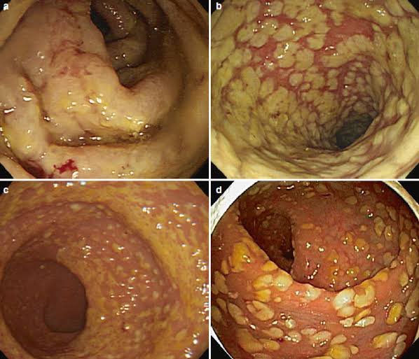 RebMedicina's tweet photo. 📌 COLITIS PSEUDOMEMBRANOSA 

Inflamación de la mucosa del colon caracterizada por la formación de placas blanquecinas o amarillentas

Etiología: Clostridium Difficile

Asociada al uso de antibióticos https://t.co/3BbCn19Zer