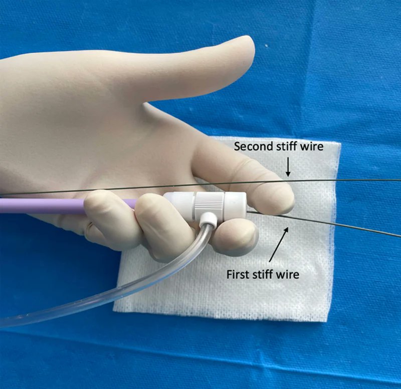 PCRonline 🫀 (@pcronline) on Twitter photo How to deal with ilio-femoral tortuosity during #TAVI : the buddy wire technique to straighten the pathway.
🔗 pcronline.com/Cases-resource…
In this new My Toolkit 🧰⚙️🔨 article, <a href="/Vinscesario/">Vincenzo Cesario</a> <a href="/kiadeb87/">Chiara De Biase</a> and <a href="/didier_tchetche/">Didier Tchetche</a> share a practical step-by-step method to overcome aortic and How to deal with ilio-femoral tortuosity during #TAVI : the buddy wire technique to straighten the pathway.
🔗 pcronline.com/Cases-resource…
In this new My Toolkit 🧰⚙️🔨 article, <a href="/Vinscesario/">Vincenzo Cesario</a> <a href="/kiadeb87/">Chiara De Biase</a> and <a href="/didier_tchetche/">Didier Tchetche</a> share a practical step-by-step method to overcome aortic and