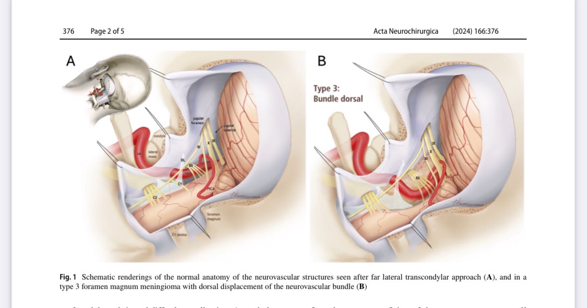 Just published with an operative video: How to resect our type 3 Foramen Magnum Meningioma when the lower cranial nerves and vertebral artery are blocking access to the tumor.