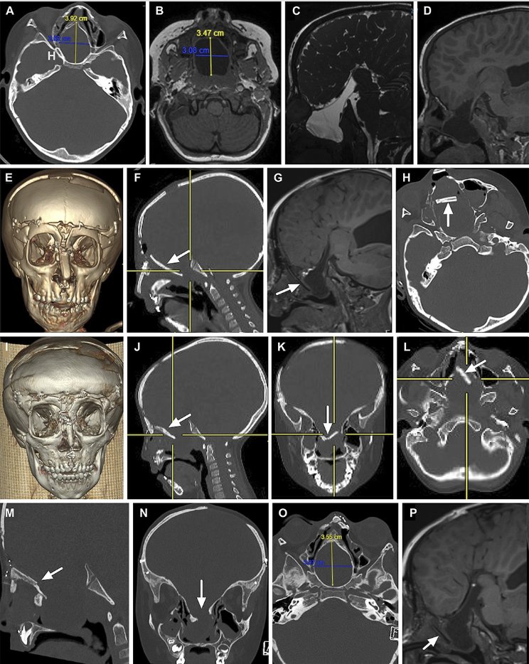 Neurosurgery Publications (@neurosurgerycns) on Twitter photo #NEUNew Pediatric Congenital Anterior Skull Base Encephaloceles and Surgical Management:A Comparative Review of 22 Patients Treated Transnasally, Transcranially, or Combined Approach With a Review of the Literature by Kameda-Smith et al <a href="/GOSH_NeuroSurg/">Great Ormond Street Neurosurgery</a> <a href="/CNS_Update/">CNS</a> <a href="/SmrutiPatelMD/">Smruti Patel, MD</a> #NEUNew Pediatric Congenital Anterior Skull Base Encephaloceles and Surgical Management:A Comparative Review of 22 Patients Treated Transnasally, Transcranially, or Combined Approach With a Review of the Literature by Kameda-Smith et al <a href="/GOSH_NeuroSurg/">Great Ormond Street Neurosurgery</a> <a href="/CNS_Update/">CNS</a> <a href="/SmrutiPatelMD/">Smruti Patel, MD</a>