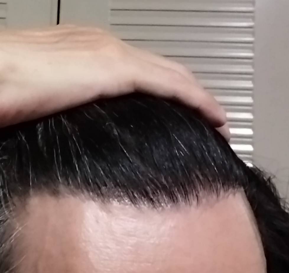 pagepagetan's tweet photo. 以前Xに投稿されていた、なかなか発毛しない、スカスカだと多くの方から心配されていた方です。術後11ヶ月経ちしっかり濃くなりました✨
#7ヶ月待ちアブソリュートヘアークリニックコンキアット先生施術
#11月3日にキャンセル空きあります https://t.co/ut1UbxvhDI