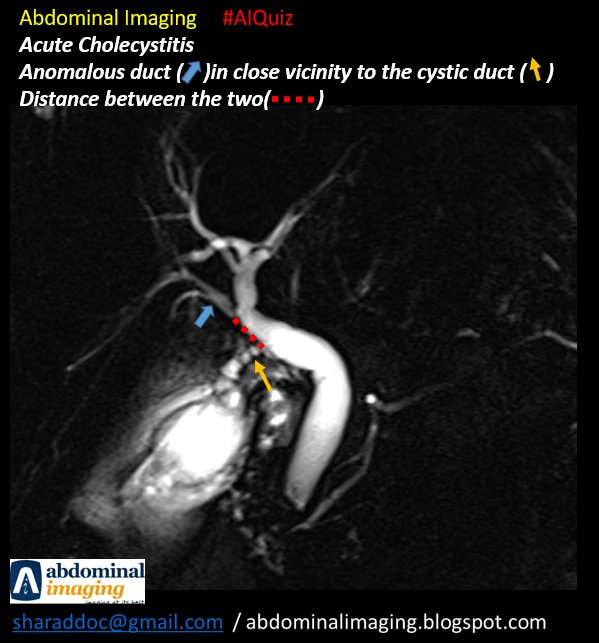 abdo_imaging's tweet image. Abdominal Imaging #AIQuiz 

Intraductal Biliary Anatomy - an imp part of a MRCP Report, esp in pre cholecystectomy status.

2 anomalies

1. Rt post from Lt
2. Acc. Rt post with extra hepatic insertion
3. Note distance from cystic duct

#FOAMed #foamrad #radtwitter   #Radiology