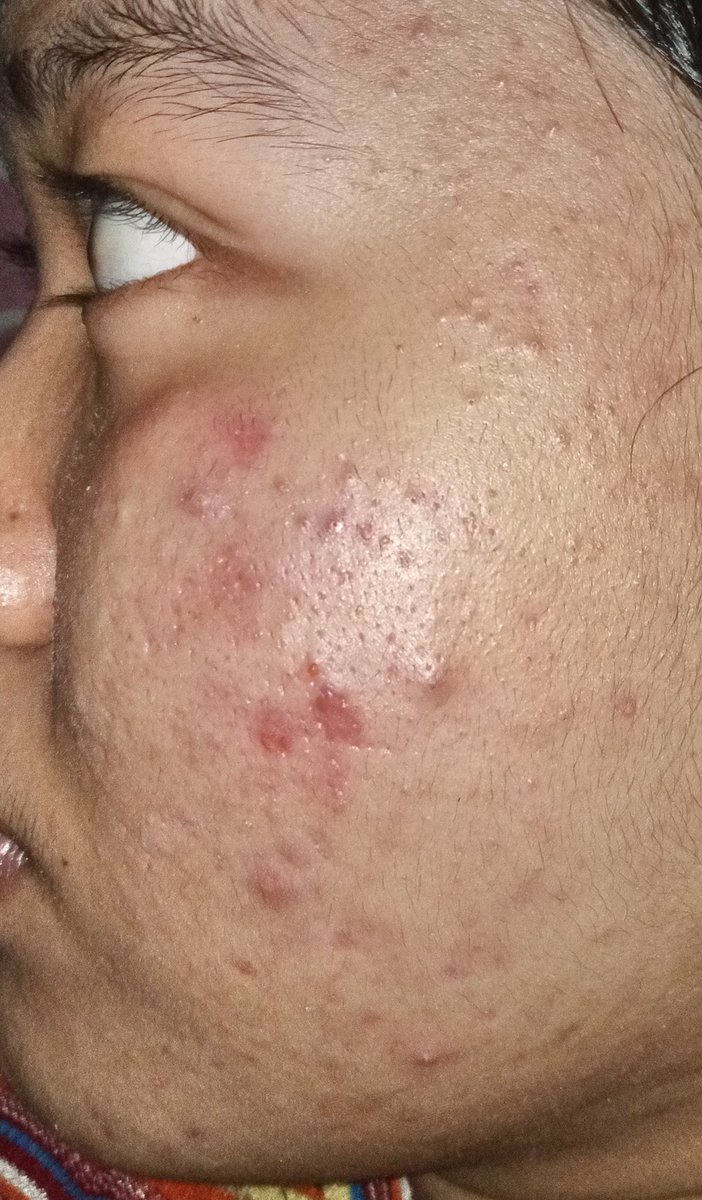 washitbola's tweet photo. meanwhile hasil dari skincare korea yg udah sustain itu🥹 ga akan ganti sampe dunia jadi onde-onde https://t.co/mQVoh1bbv7