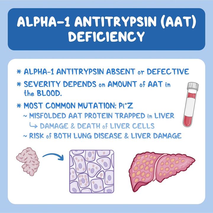 OsmosisMed's tweet photo. Today's #PathologyReview is about alpha-1 antitrypsin deficiency, a rare #GeneticDisorder in which the protein is defective or absent, causing lung & liver disease.
Learn more: https://t.co/ommxPWdkoy
Get a free trial of Osmosis from Elsevier: https://t.co/Ipj9vGAMhU https://t.co/MVqe29JZWH