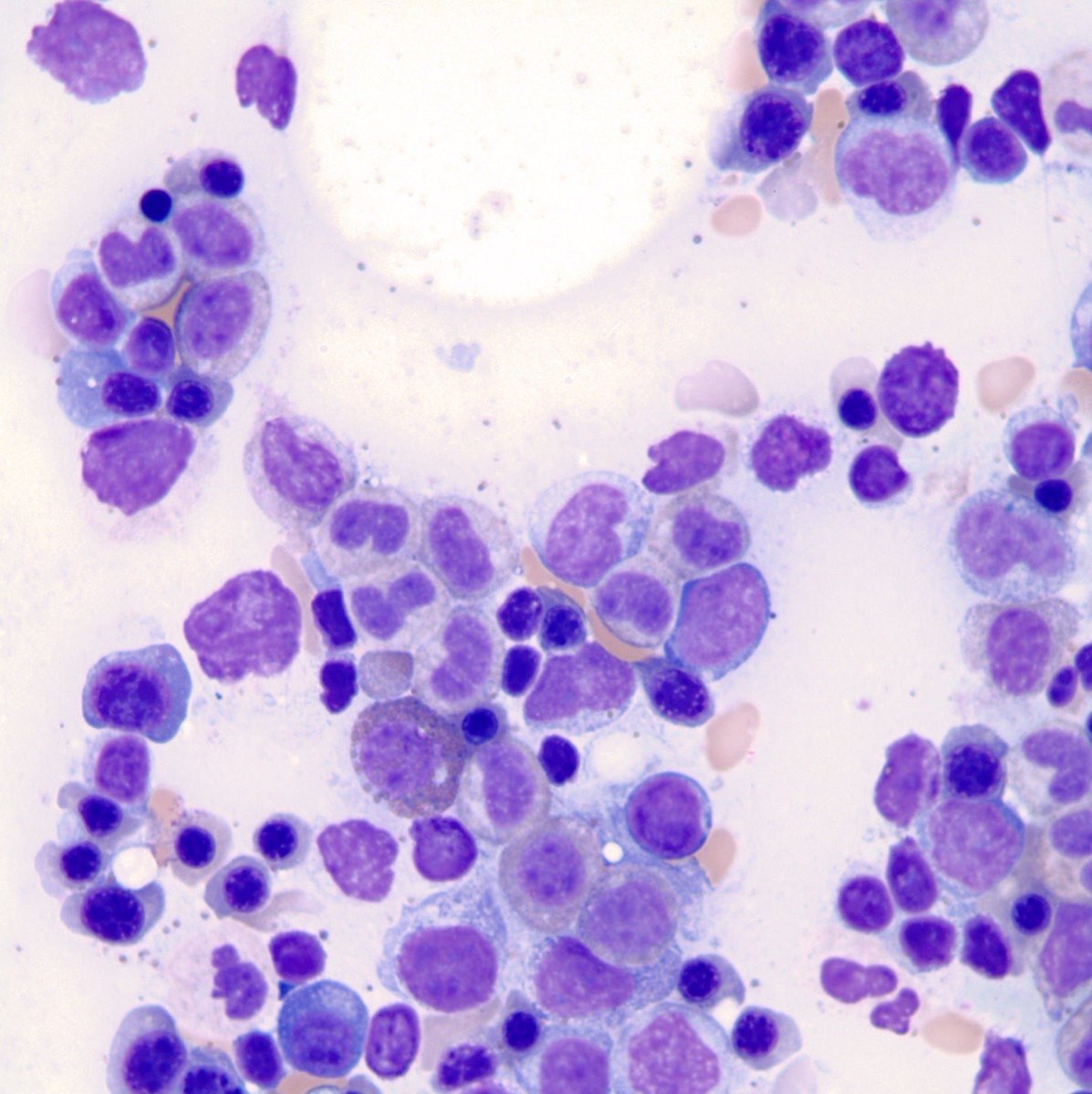 Pathoutlines's tweet photo. Cancer Precursor Project – Characteristics Of Premalignant Precursors, Part 5a (Hematopathology)
This essay discusses precursors associated with hematologic malignancies.
Essay: https://t.co/55W5mV6qrb
#Pathology #CuringCancerNetwork #CancerResearch #PathologyOutlines https://t.co/RbiN3EQsJd