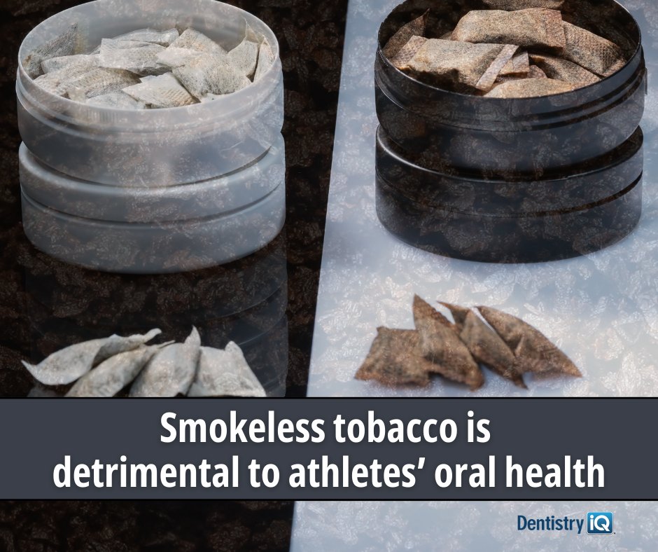 DentistryIQ's tweet image. Smokeless tobacco has been associated with sports performance for decades. Why do athletes who are striving to be in peak physical health turn to substances for support?🤔 

Learn more and read the full article now: bit.ly/3XTCicW

 #dentistryiQ #smokeless #tobacco