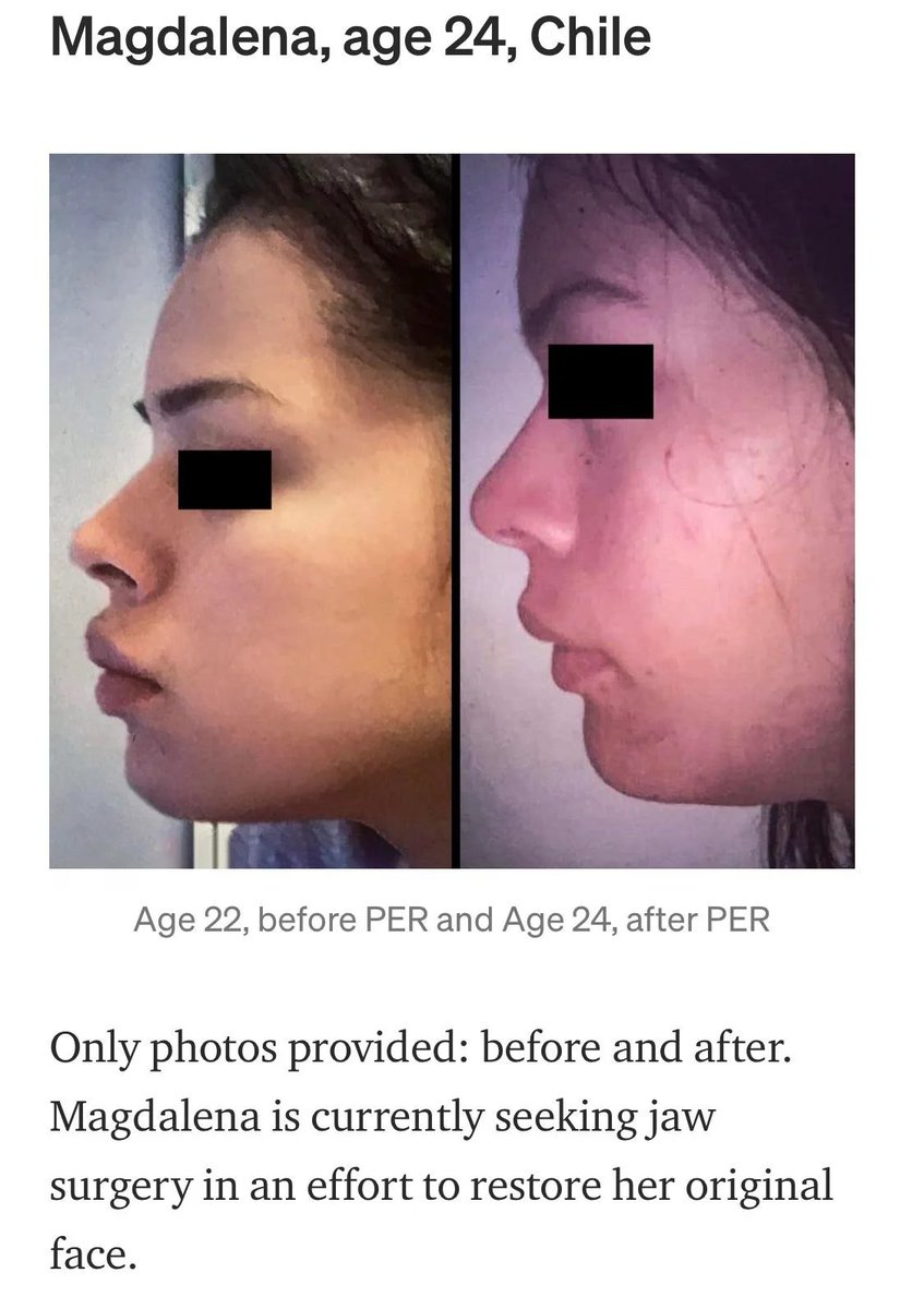 JohnFlutter's tweet image. Braces can cause facial damage.
Crowding is often treated by removing the premolar teeth and closing the gap with braces.
But this is problematic because it pulls the front teeth back, which pulls the jaw bone with it.
Consequently, the patient's jawline may appear weaker,…