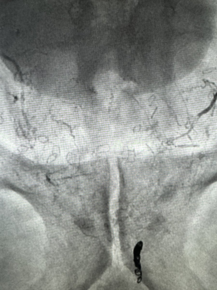 DrGluRu's tweet image. 3 prostatic arteries embolized w/ glue & coils. 1 microcatheter. 1 happy patient. #PAE #BPH #irad @SIR_ECS @SIRRFS @MountSinaiIR @bonesz