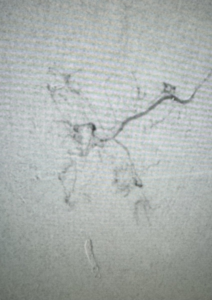 DrGluRu's tweet image. 3 prostatic arteries embolized w/ glue & coils. 1 microcatheter. 1 happy patient. #PAE #BPH #irad @SIR_ECS @SIRRFS @MountSinaiIR @bonesz