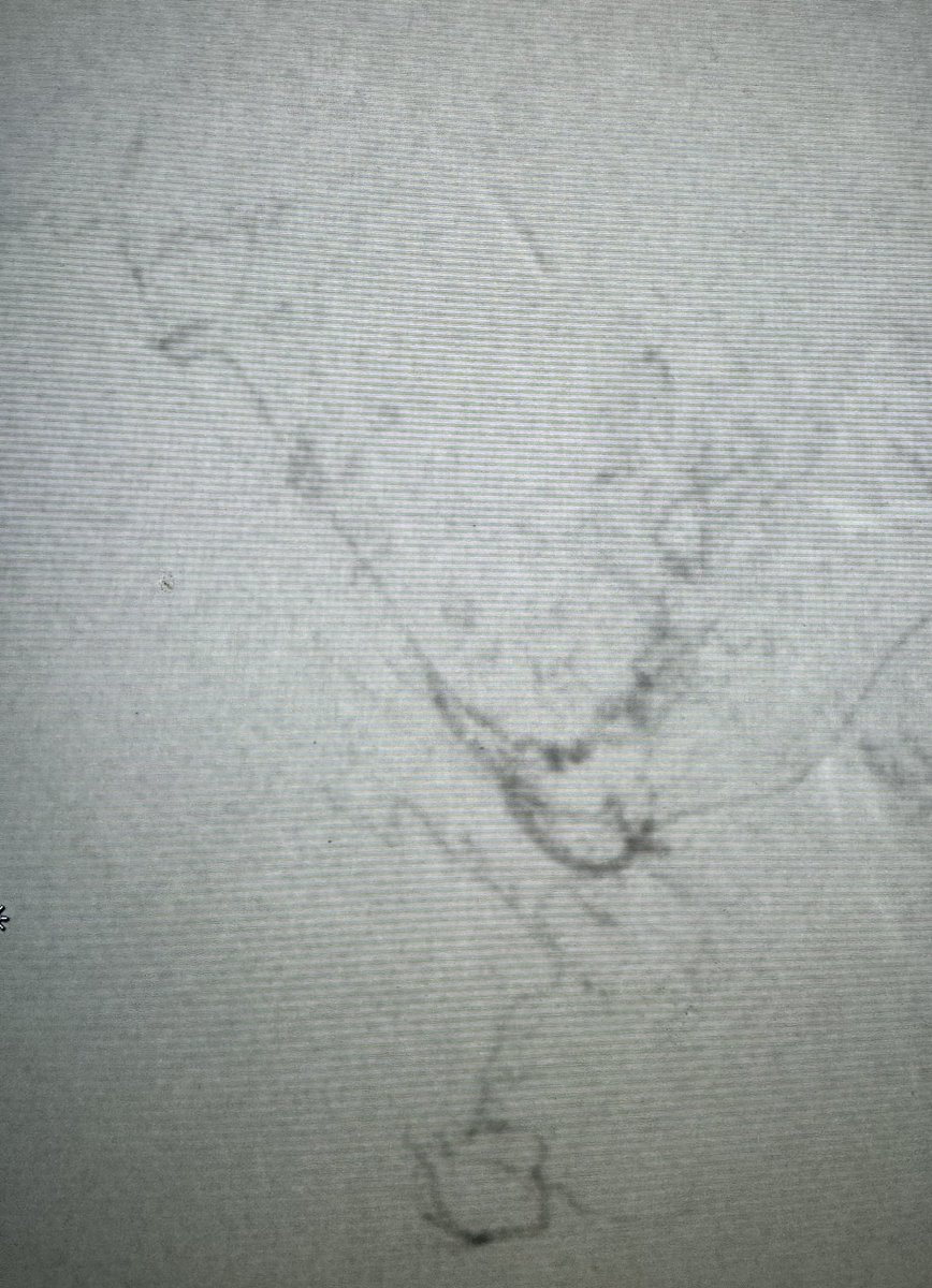 DrGluRu's tweet image. 3 prostatic arteries embolized w/ glue & coils. 1 microcatheter. 1 happy patient. #PAE #BPH #irad @SIR_ECS @SIRRFS @MountSinaiIR @bonesz