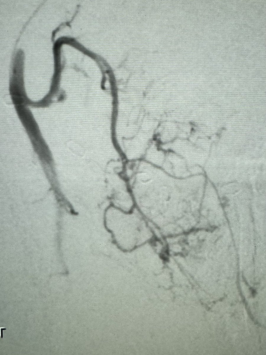 DrGluRu's tweet image. 3 prostatic arteries embolized w/ glue & coils. 1 microcatheter. 1 happy patient. #PAE #BPH #irad @SIR_ECS @SIRRFS @MountSinaiIR @bonesz