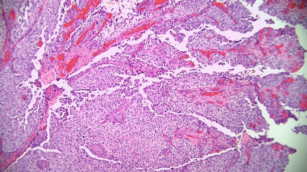OOPathMD's tweet photo. Now THAT is papillary! Papillary urothelial carcinoma (high grade). https://t.co/NR9hpa8eXe