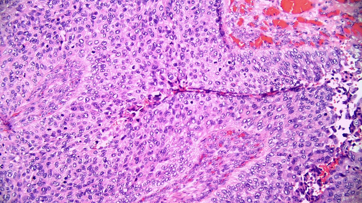 OOPathMD's tweet photo. Now THAT is papillary! Papillary urothelial carcinoma (high grade). https://t.co/NR9hpa8eXe