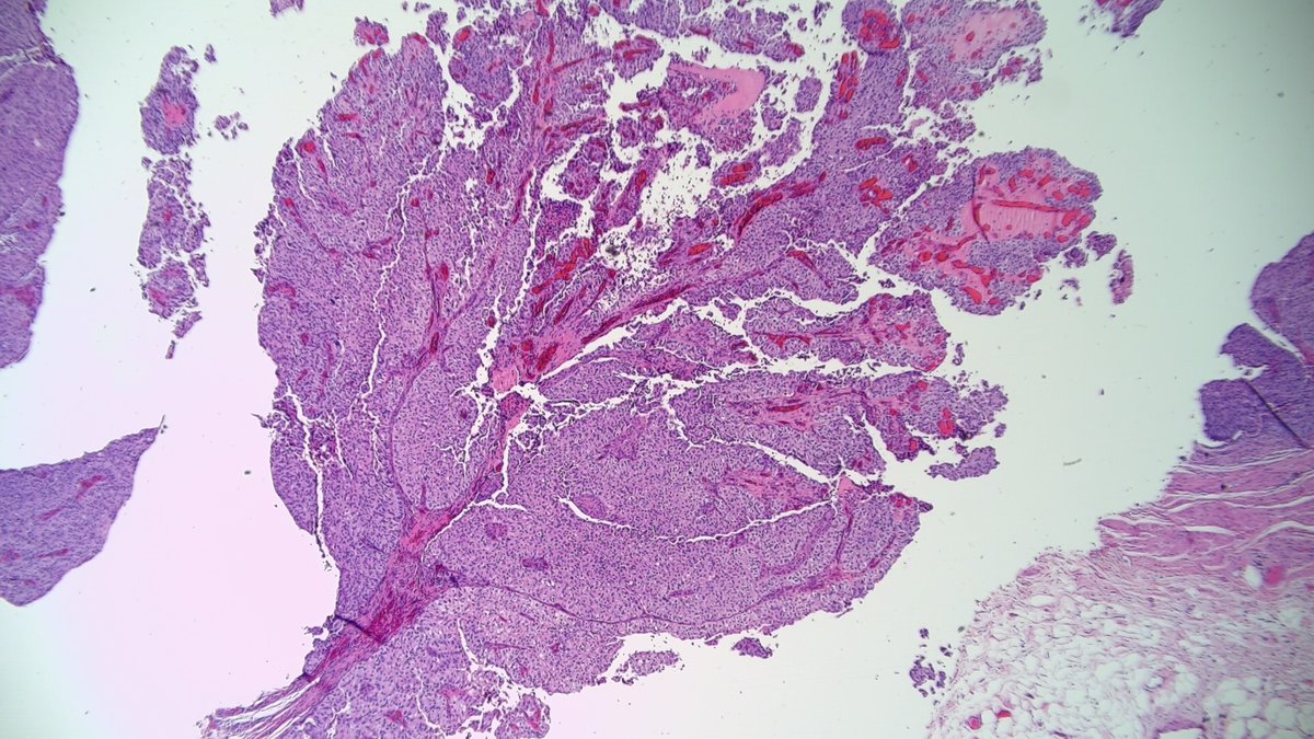 OOPathMD's tweet photo. Now THAT is papillary! Papillary urothelial carcinoma (high grade). https://t.co/NR9hpa8eXe