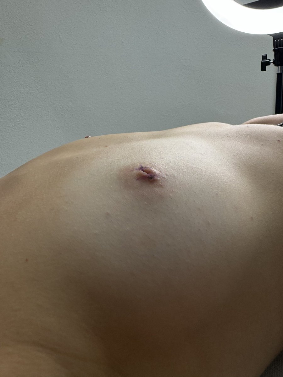 bluebodyart's tweet photo. • Capezzoli introflessi - prima e dopo ✨✨ • https://t.co/ZewH2SKubv