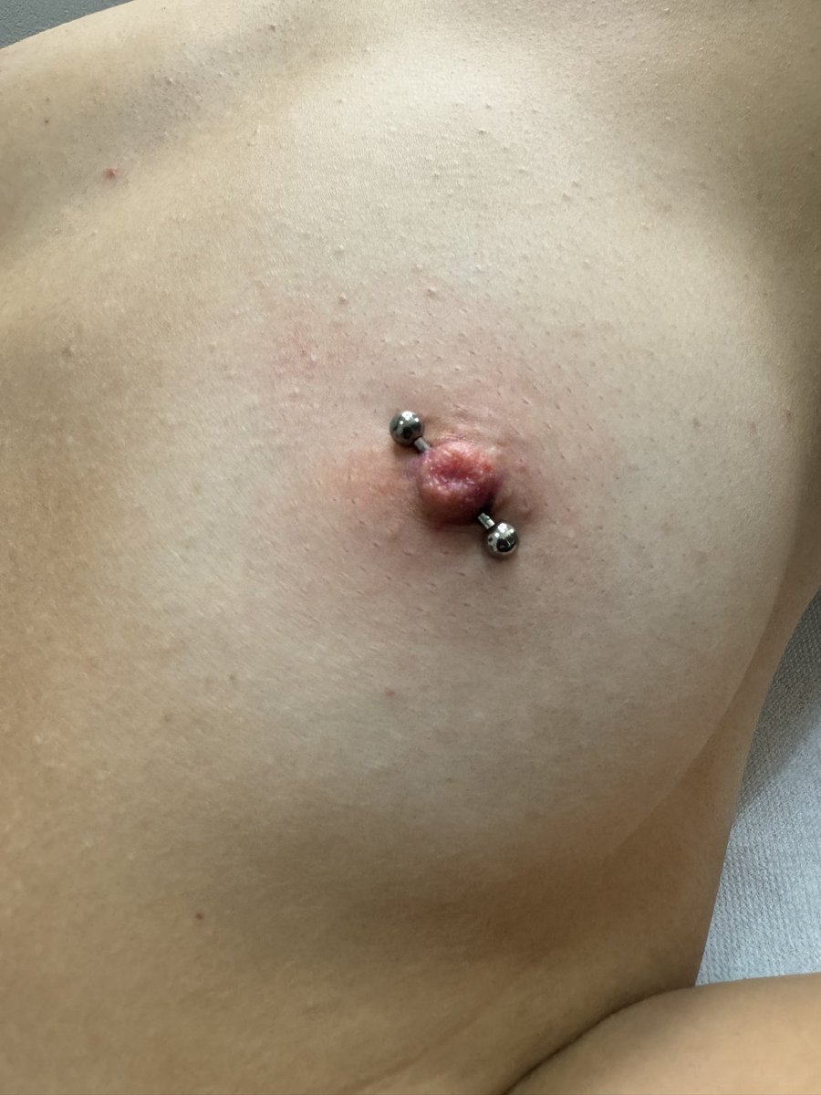 bluebodyart's tweet photo. • Capezzoli introflessi - prima e dopo ✨✨ • https://t.co/ZewH2SKubv