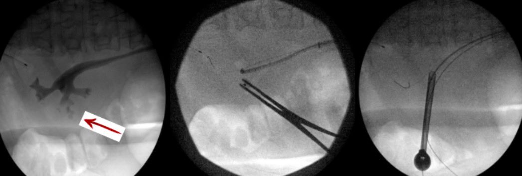 Diverticular stones (red arrow) are tough to treat, even for experience PCNL surgeons. Using the Bull’s Eye fluoroscopic technique, we successfully access the diverticulum, places wired down the ureter, &amp; achieve a stone-free result on post-op CT. The patient did well
#pcnl