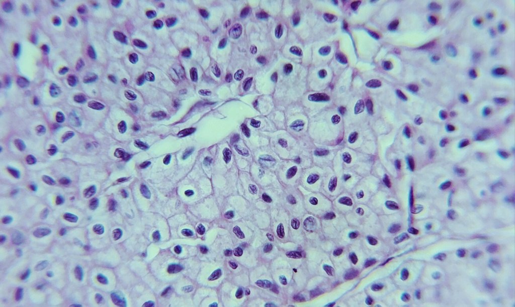 AfgPath's tweet photo. Nuclear grooves of chromophobe Renal cell ca https://t.co/I1IEkcWp04