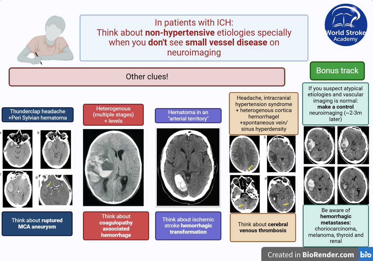 World Stroke Academy (@worldstrokeed) on Twitter photo #Mondaytip
From <a href="/Ash_Shoamanesh/">Ashkan Shoamanesh</a> presentation in WSO/WSA #ICH Educational Program:
☝️Consider atypical (i.e., non-hypertensive) etiologies, especially if markers of #cSVD are absent on initial neuroimaging
🧠Keep this and other #clues in mind when evaluating patients with ICH #Mondaytip
From <a href="/Ash_Shoamanesh/">Ashkan Shoamanesh</a> presentation in WSO/WSA #ICH Educational Program:
☝️Consider atypical (i.e., non-hypertensive) etiologies, especially if markers of #cSVD are absent on initial neuroimaging
🧠Keep this and other #clues in mind when evaluating patients with ICH