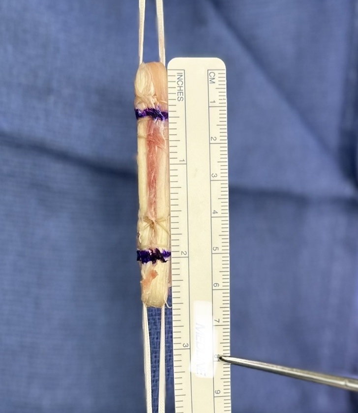 GioMedina_MD's tweet image. No Clinically Significant Differences in Outcomes after Anterior Cruciate Ligament Reconstruction When Comparing Quadriceps, Bone Patellar Tendon Bone, and Hamstring Autografts of 9mm or Greater. - Arthroscopy arthroscopyjournal.org/article/S0749-…
@DocMatzkin @natlowenstein @MGBOrthopedics