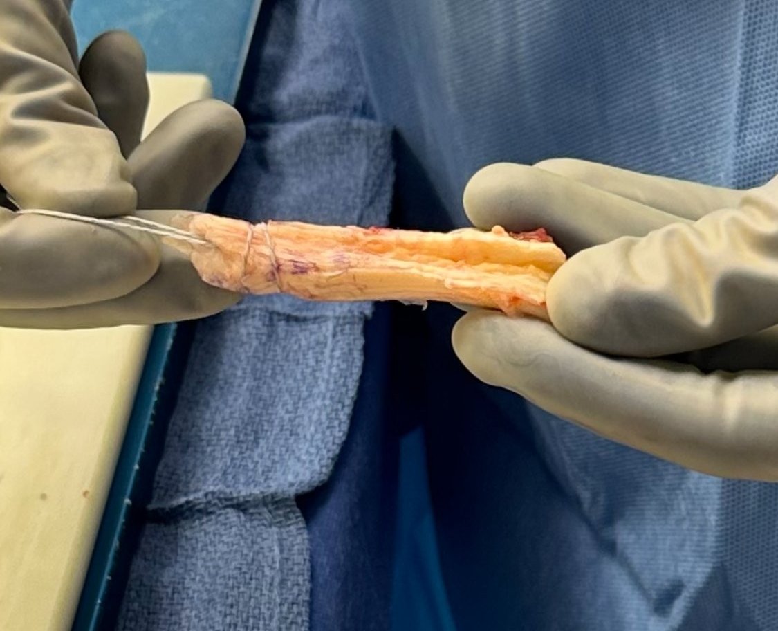 GioMedina_MD's tweet image. No Clinically Significant Differences in Outcomes after Anterior Cruciate Ligament Reconstruction When Comparing Quadriceps, Bone Patellar Tendon Bone, and Hamstring Autografts of 9mm or Greater. - Arthroscopy arthroscopyjournal.org/article/S0749-…
@DocMatzkin @natlowenstein @MGBOrthopedics