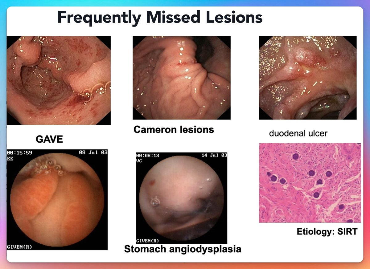 EndoCollabcom's tweet photo. Frequently Missed Lesions https://t.co/k0mGCBvzeB
