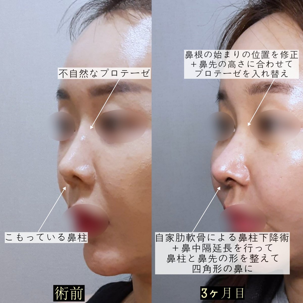 ondops_jp's tweet photo. 【ONDO美容外科】

◻︎自家肋軟骨に���る鼻中隔延長
◻︎プロテーゼ入れ替え(鼻根の始まり修正)
◻︎鼻注下降術

#オンド美容外科 
#温度美容外科 
#鼻整形 https://t.co/hlMZgn1BHK
