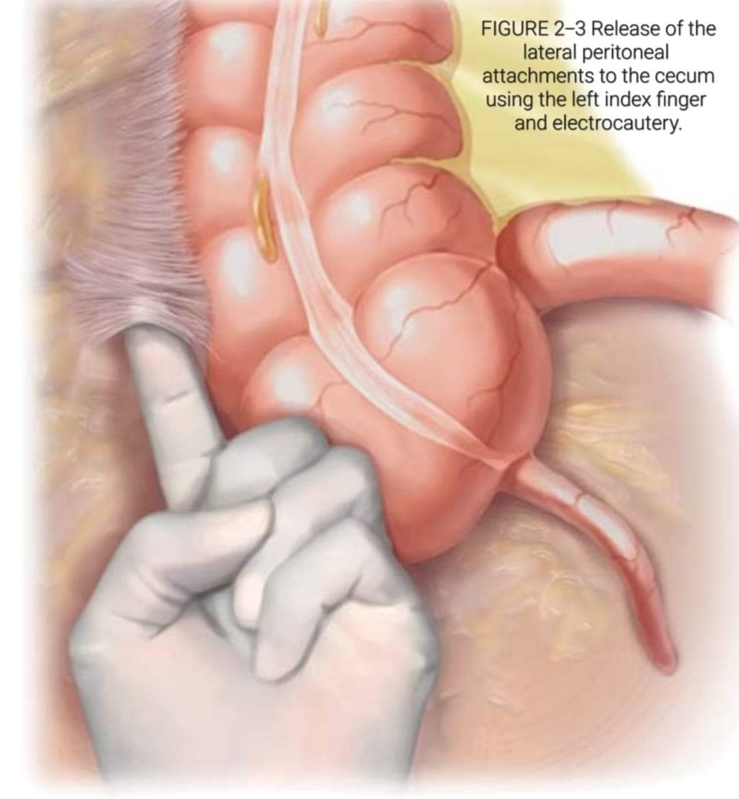 DRAFTABAHMED7's tweet photo. Mobilization of the Colon Caution; 
See text ⤵️⤵️⤵️
𝗥𝗲𝗳:Colon &amp; Rectal Surgery, Abdominal Operations, 2nd ed. https://t.co/4lMlBU17cd