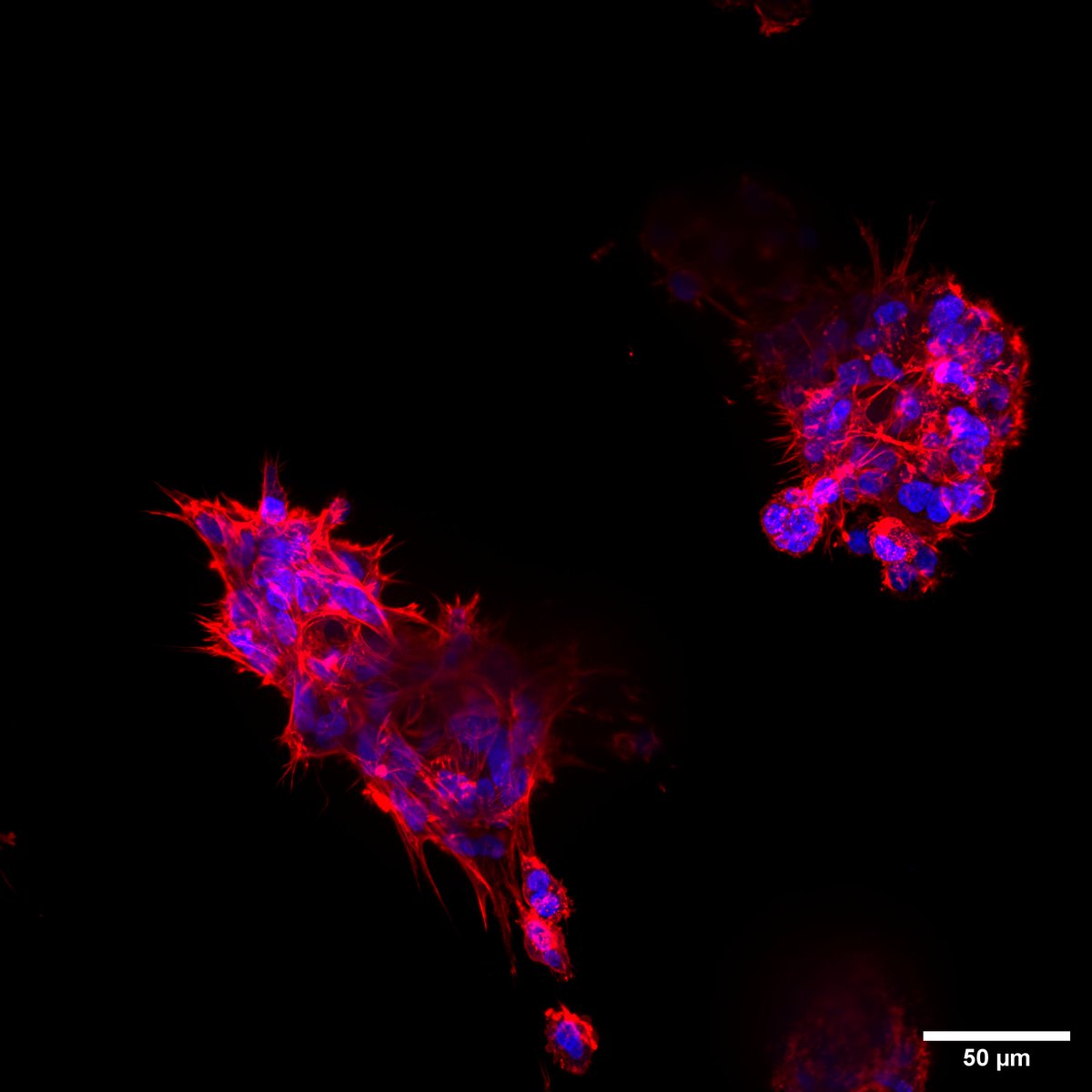 My PhD work is now available in bioRxiv! biorxiv.org/cgi/content/sh…  We investigated how mesenchymal-epithelial transition affects tumor growth, focusing on cell adhesion signaling pathways and morphology-driven changes in the interactions with immune cells ⬇️🧵<a href="/FischerFriedLab/">Fischer-Friedrich lab</a>