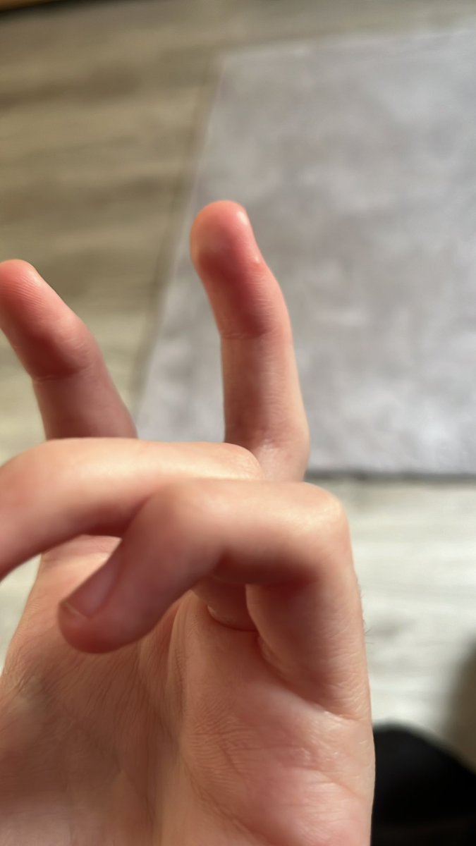 arontality's tweet photo. FUCKING SHIT SOME BITCHASS MOSQUITO TOOK MY BLOOD ON MY MIDDLE FINGER FUCK YOU TOO I GUESS https://t.co/YbYJkZiXBg