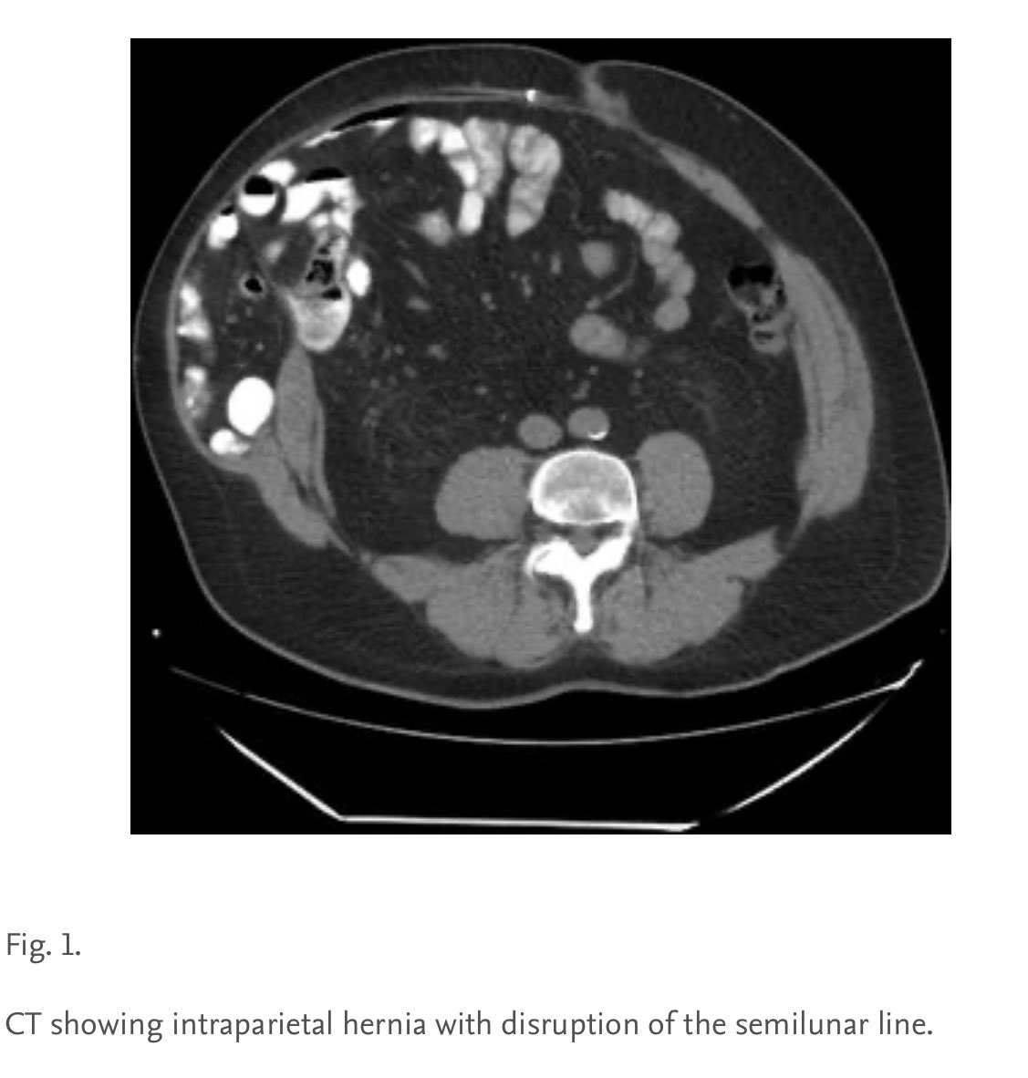 cirugiaespanola's tweet photo. “Surgical management of recurrent intraparietal #hernia following disruption of the semilunar line by pararectus incision” 🪡

@aecirujanos @AecPared 
@me4_so @me4hernia 

#AWSurgery #Some4hernia #CirEsp

🔗https://t.co/Mprwb9ySxF https://t.co/rQq7kMjZR8