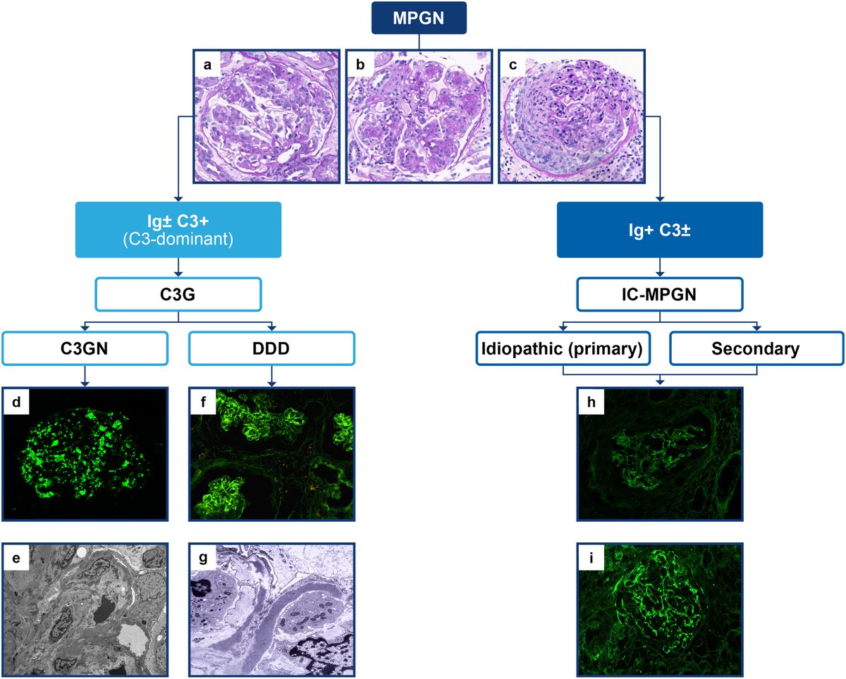 ASPNeph's tweet photo. Challenges in the Diagnosis and Management of IC-MPGN and C3G
@KIREPORTS #MPGN
https://t.co/uBSk766Ia2 https://t.co/BHCa20GkqR
