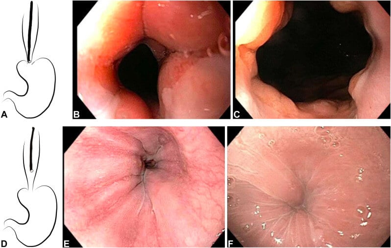 Ashton Ellison and colleagues present "An endoscopic scoring system for achalasia: the CARS score." Read the article here: hubs.ly/Q02NqfK_0. #GITwitter #GIE #GIEJournal