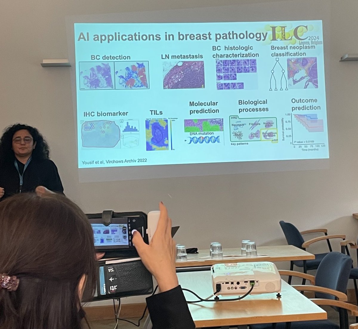 GitteJoergensen's tweet photo. Day 2 #ILCsymposium @FresiaPareja from @MSKCancerCenter highlighting how we can use #AI to help correctly identify #lobular breast cancer #NotAlwaysALump #lobmob 🦞🛟 🕸️👀 https://t.co/DQAU27o0m5