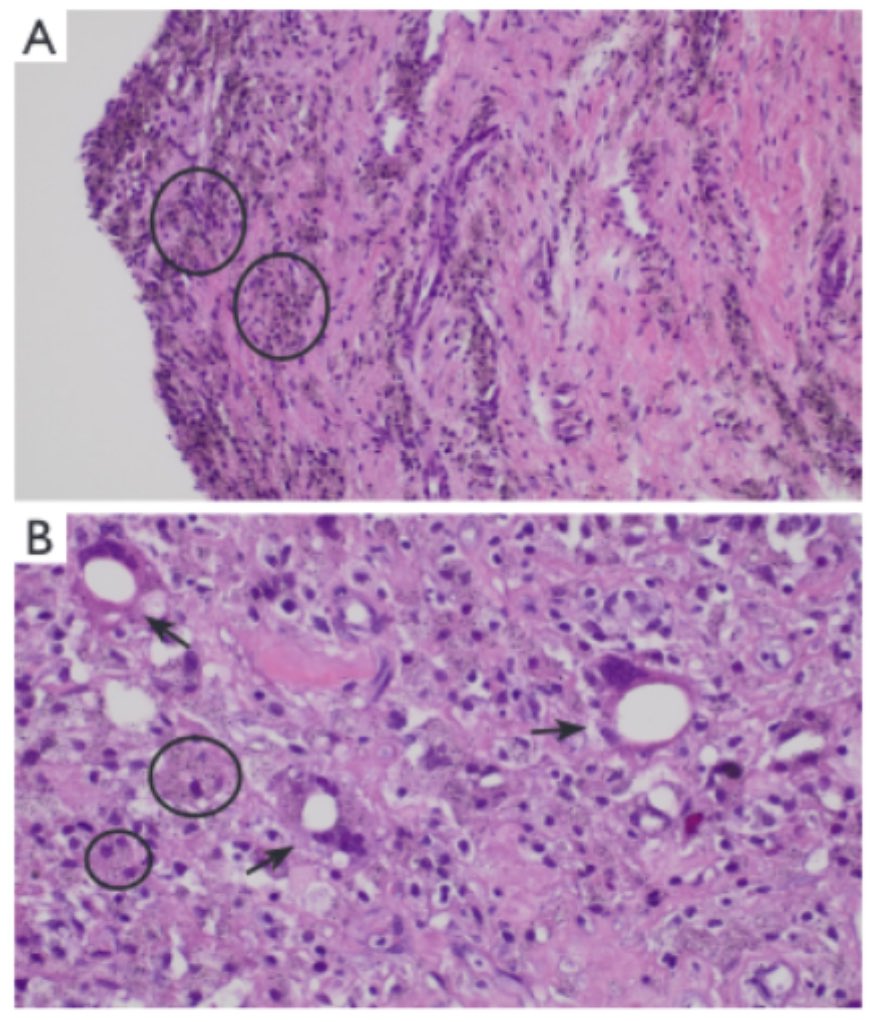 You probably know me for my passion for sports... but I have a second line of research based on prosthetic complications... Recently, we reported: “Increased cortical density in popliteal lymphadenopathy to help differentiate adverse local tissue reaction”