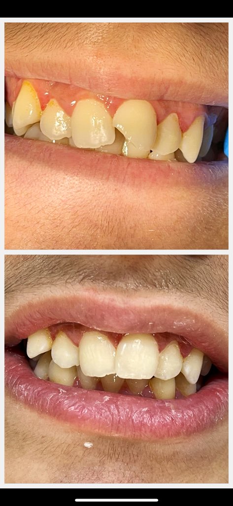 -12 y.o patient came with a fractured #21 after he fell of from his bicycle 
-Pulp vitality test was performed to ensure the pulp status 
-direct resin composite A2 used to restore the tooth

The patient was happy with the results and promised me to sell his bicycle 👍🏻